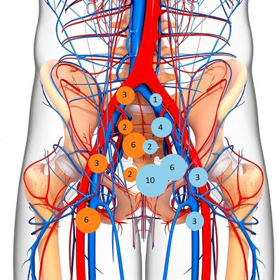 FDG-PET/CT in the Radiotherapy Treatment Planning of Locally Advanced Anal Cancer: A Monoinstitutional Experience